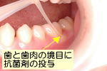歯と歯肉の境目に抗菌剤の投与