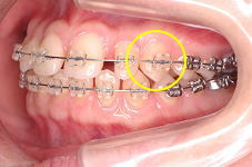 ワイヤーは一直線になり、犬歯の捻転も改善