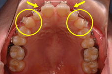 前歯部でワイヤーのたわみが大きく、犬歯が遠心に捻転している