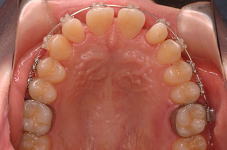 ワイヤーのたわみ、犬歯の捻転が大分改善され、歯列全体がきれいなアーチ型に