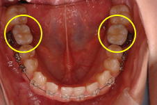小臼歯の近心傾斜（前方への傾斜）が強く注意が必要
