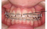 全体的なデコボコや歯の捻じれが大きな症例