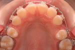 全体的なデコボコや歯の捻じれが大きな症例