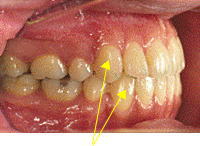 理想的な犬歯の位置関係