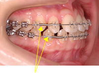 上顎の犬歯に対して下顎の犬歯が前方に位置している