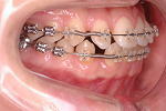 犬歯の移動から1か月　右側