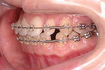 犬歯の移動から1か月 左側