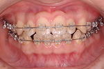 犬歯の移動終了・犬歯の移動から4か月　正面
