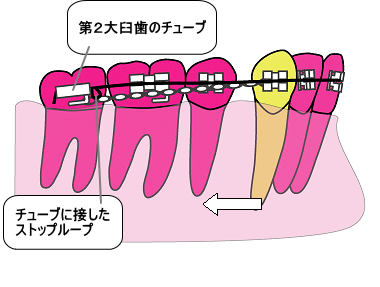 歯の移動