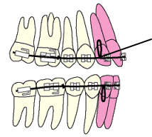 V-loopが閉じることで前歯が後退し、すき間が閉じる 