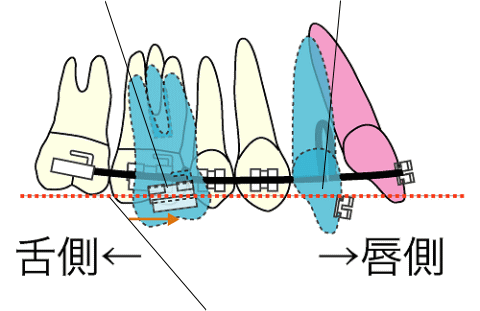 アンカーロスによる近心傾斜とトルクコントロールの不足により舌側傾斜
