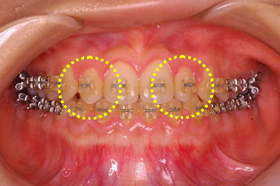 正常な大きさよりも小さい側切歯を形態修正せずにスペースを閉鎖した状態