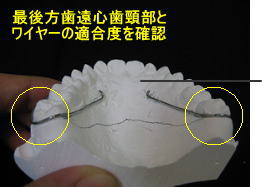 最後方歯遠心歯頸部とワイヤーの適合度を確認