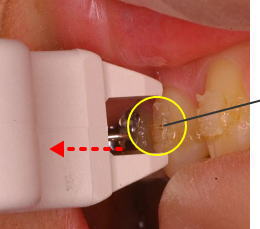 ボンディング材が歯面に残っている状態