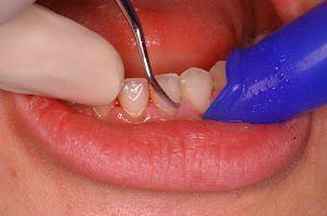 歯面にボンディング材やセメントを超音波スケーラーで取り除き、ブラシなどで歯面を研磨する