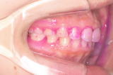 矯正治療完了後、歯の磨き残しが多い患者さんの例　写真1