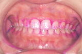 矯正治療完了後、歯の磨き残しが多い患者さんの例　写真2