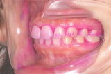 矯正治療完了後、歯の磨き残しが多い患者さんの例　写真3