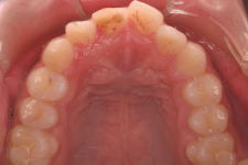 叢生、上下顎前突（両突歯列）　治療前　写真4
