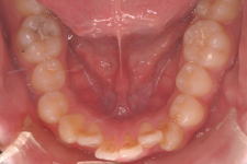 叢生、上下顎前突（両突歯列）　治療前　写真5