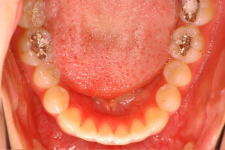中立咬合、両突歯列、左側偏位顎　治療前　写真5