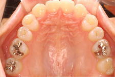 中立咬合、両突歯列、左側偏位顎　治療後　写真4