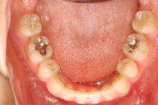 中立咬合、両突歯列、左側偏位顎　治療後　写真5