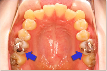 矢印の歯が不適切な修復物により修復物の間からむし歯が広がっている