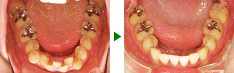 中立咬合、叢生、両突、右側偏位顎　治療前後　写真5
