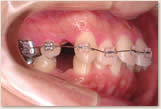 上突咬合、両突歯列 治療開始後　右側
