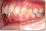 上突咬合、両突歯列　治療前　左側