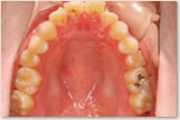 開咬をともなう骨格性下顎前突症 治療前　上顎