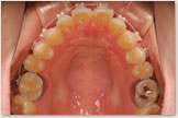 開咬をともなう骨格性下顎前突症 開始後　上顎