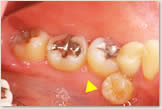 下顎左側第2小臼歯（左下5番）が舌側（内側）に転位