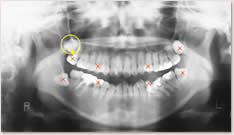 ×印は抜歯部位、○で囲まれた右上８番（第３大臼歯：親知らず）は失活歯である右上７番を抜歯して牽引する