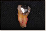 失活歯であるため黒く変色し、修復物のつなぎ目に二次う蝕（むし歯）を認める