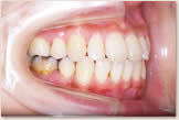 開咬をともなう骨格性下顎前突症 治療後　右側