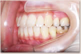開咬をともなう骨格性下顎前突症 治療後　左側