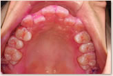 歯周組織検査　上顎