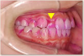 歯周組織検査　右側