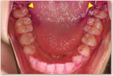 歯周組織検査　下顎
