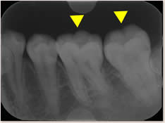 デンタルＸ線写真においても下顎左側第１、２大臼歯（６、７番）の咬合面（噛む面）にむし歯を示す黒い影はみとめられなかった。