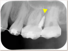 ▼ アンカースクリューは大臼歯と大臼歯の歯根の間に埋入しデンタルＸ線写真で確認しました