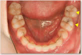 ▲ 下顎左側６、７番のむし歯は動的治療期間中に進行を認めなかった
