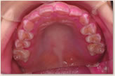 2006年唾液検査開始時　上顎
