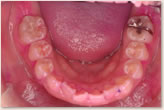 2006年唾液検査開始時　下顎