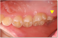 上顎右側第2大臼歯