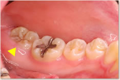 下顎左側第2大臼歯