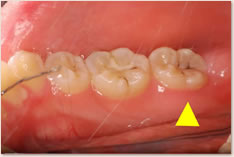 下顎右側第２大臼歯