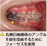 ▲ 右側臼歯関係のアングルII級を改善するためにフォーサスを使用